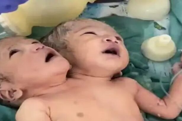 Indore Two Headed Girl