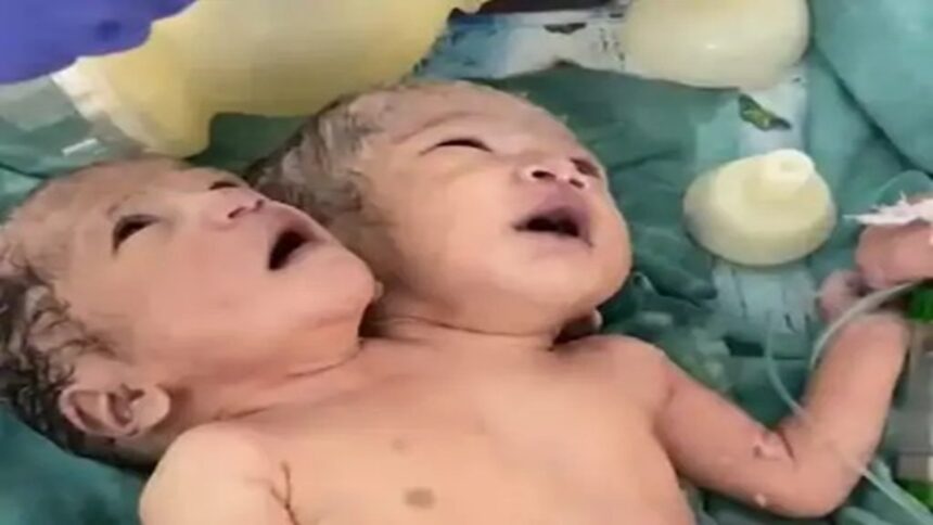 Indore Two Headed Girl